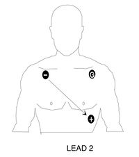 Placement for monitoring Lead II