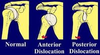 Dislocation Shoulder.jpg