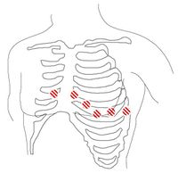 Chest Lead Placement