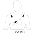 Cardiac MCL 1.jpg